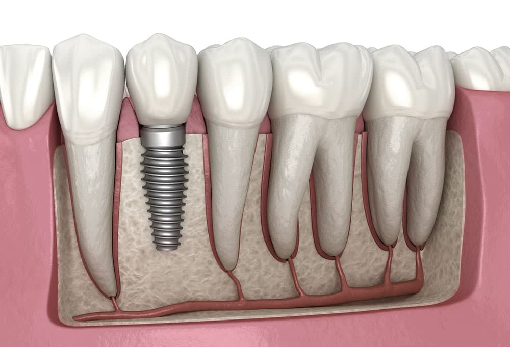 Illustration d'un implant dentaire en titane avec couronne