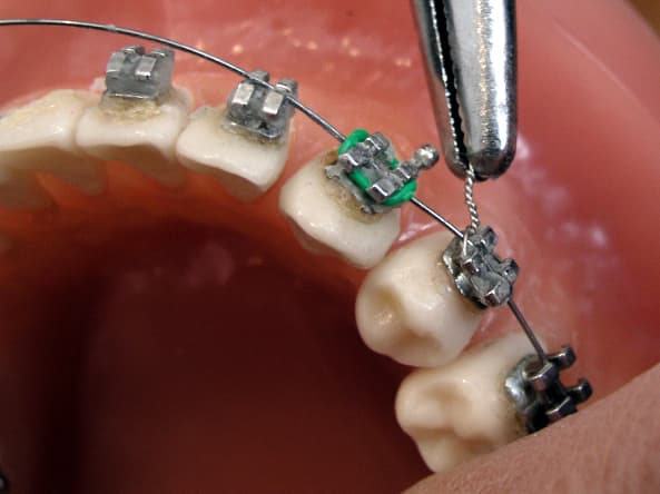 Bagues orthodontiques metalliques