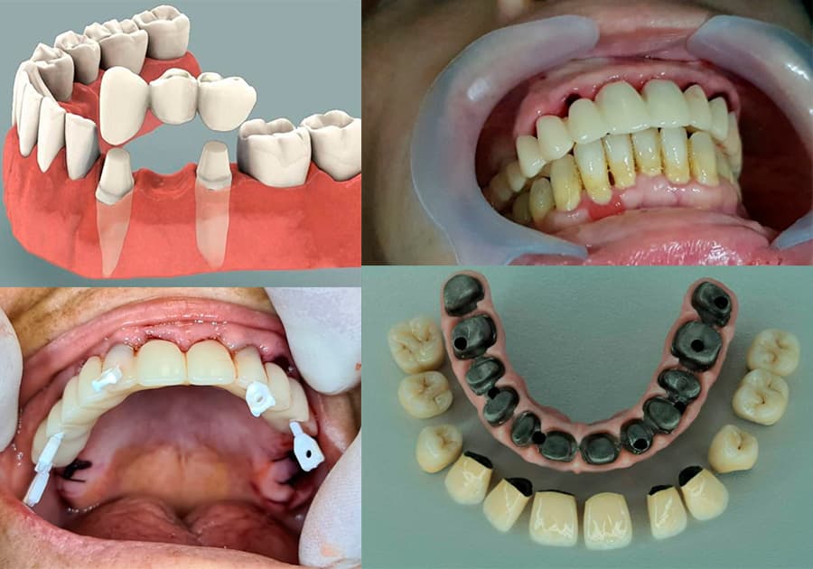 Prothese dentaire amovible complete